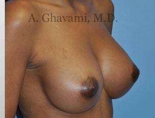 Breast Augmentation Before & After Patient #9018