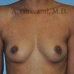 Breast Augmentation Before & After Patient #9018