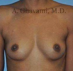 Breast Augmentation Before & After Patient #9018