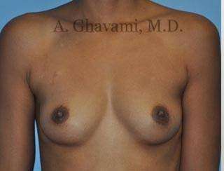 Breast Augmentation Before & After Patient #9018