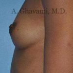 Breast Augmentation Before & After Patient #9018