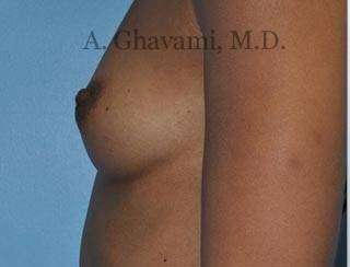 Breast Augmentation Before & After Patient #9018