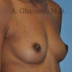 Breast Augmentation Before & After Patient #9018