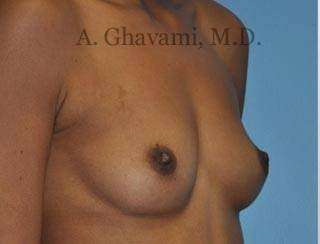 Breast Augmentation Before & After Patient #9018