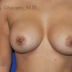 Breast Augmentation Before & After Patient #9011
