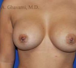 Breast Augmentation Before & After Patient #9011