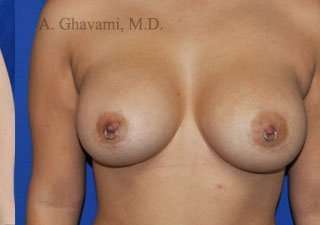 Breast Augmentation Before & After Patient #9011