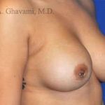 Breast Augmentation Before & After Patient #9011