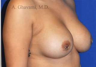 Breast Augmentation Before & After Patient #9011