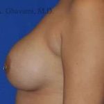 Breast Augmentation Before & After Patient #9011