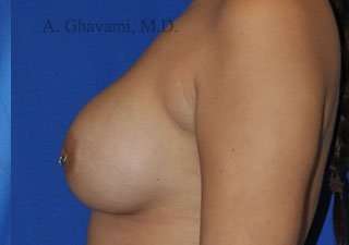 Breast Augmentation Before & After Patient #9011