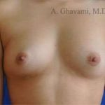 Breast Augmentation Before & After Patient #9011