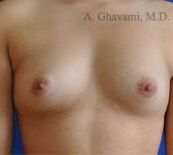 Breast Augmentation Before & After Patient #9011