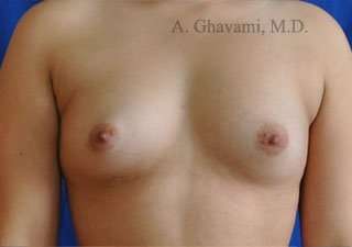Breast Augmentation Before & After Patient #9011