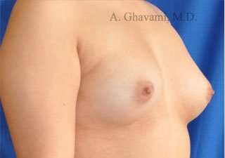 Breast Augmentation Before & After Patient #9011