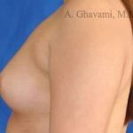 Breast Augmentation Before & After Patient #9011