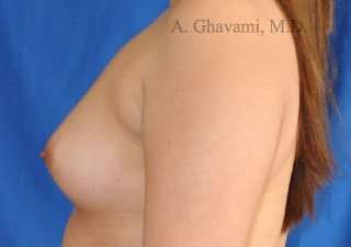 Breast Augmentation Before & After Patient #9011