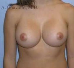 Breast Augmentation Before & After Patient #9004