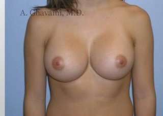 Breast Augmentation Before & After Patient #9004