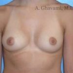 Breast Augmentation Before & After Patient #9004