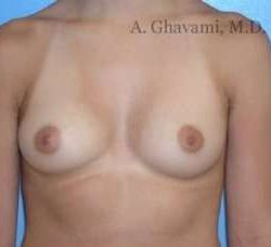 Breast Augmentation Before & After Patient #9004