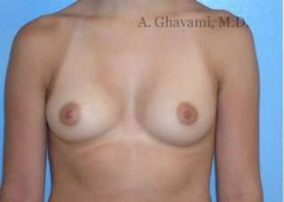 Breast Augmentation Before & After Patient #9004