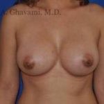 Breast Augmentation Before & After Patient #8999