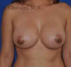 Breast Augmentation Before & After Patient #8999