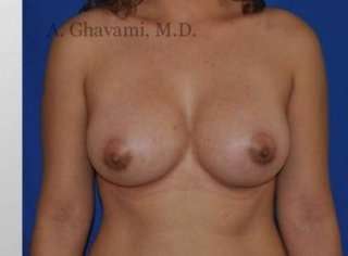 Breast Augmentation Before & After Patient #8999