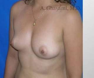 Breast Augmentation Before & After Patient #8999