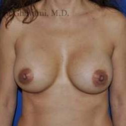 Breast Augmentation Before & After Patient #8992