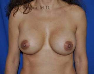 Breast Augmentation Before & After Patient #8992