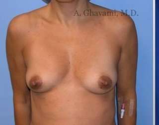 Breast Augmentation Before & After Patient #8992
