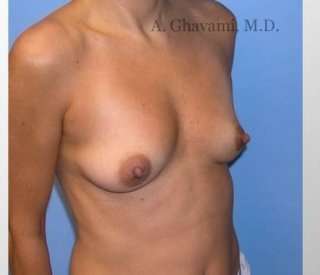 Breast Augmentation Before & After Patient #8992