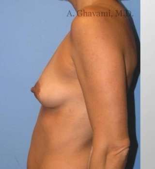 Breast Augmentation Before & After Patient #8992