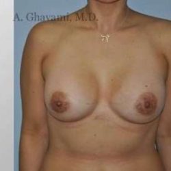 Breast Augmentation Before & After Patient #8985
