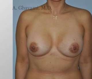 Breast Augmentation Before & After Patient #8985