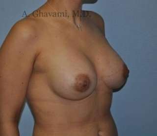 Breast Augmentation Before & After Patient #8985