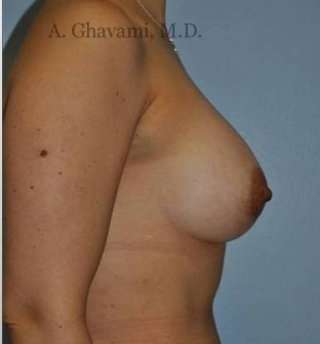 Breast Augmentation Before & After Patient #8985