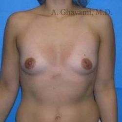 Breast Augmentation Before & After Patient #8985