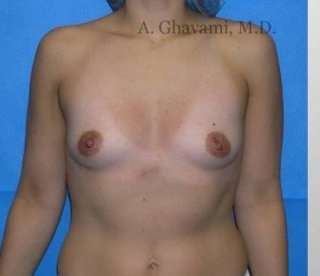 Breast Augmentation Before & After Patient #8985