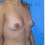Breast Augmentation Before & After Patient #8985