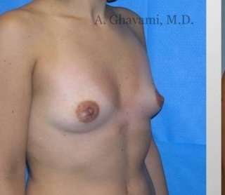 Breast Augmentation Before & After Patient #8985