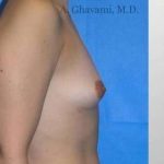 Breast Augmentation Before & After Patient #8985