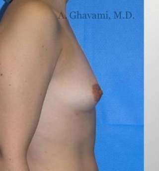 Breast Augmentation Before & After Patient #8985