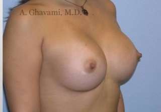 Breast Augmentation Before & After Patient #8978