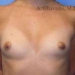 Breast Augmentation Before & After Patient #8978