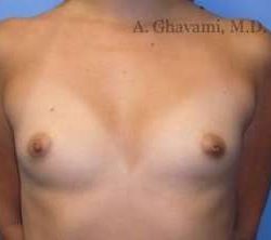 Breast Augmentation Before & After Patient #8978