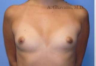 Breast Augmentation Before & After Patient #8978