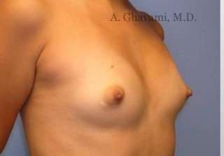 Breast Augmentation Before & After Patient #8978